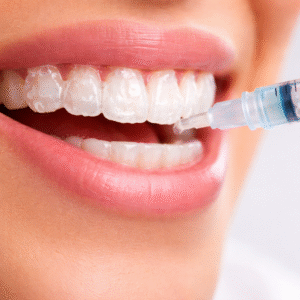 gel réminéra blanchiment dentaire lot sur commande